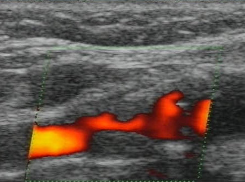 Aneurysma Diagnostik im CardioCentrum Düsseldorf