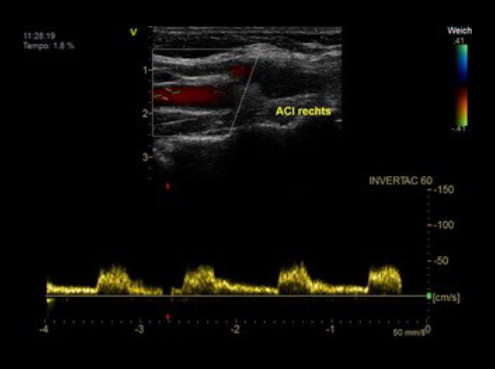 Diagnostik supraaortale Gefäße im CardioCentrum Düsseldorf