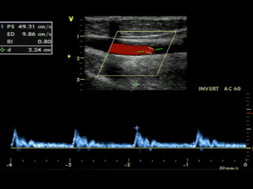 Duplexsonographie der Halsgefäße im CardioCentrum Düsseldorf