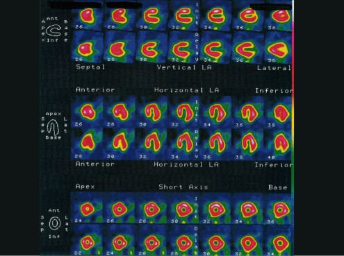 Myokardszintigrafie im CardioCentrum Düsseldorf