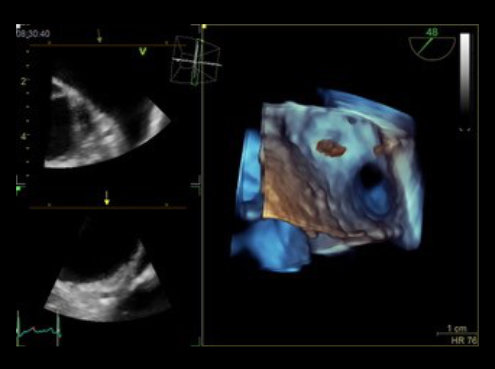 Transösophageale Echokardiographie im CardioCentrum Düsseldorf